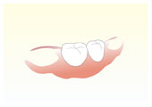 義歯の写真