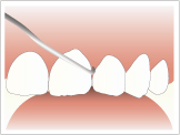 歯石除去の写真